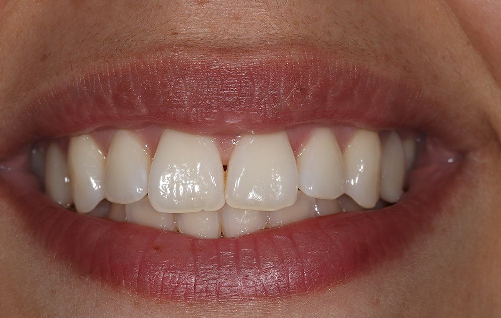 After image